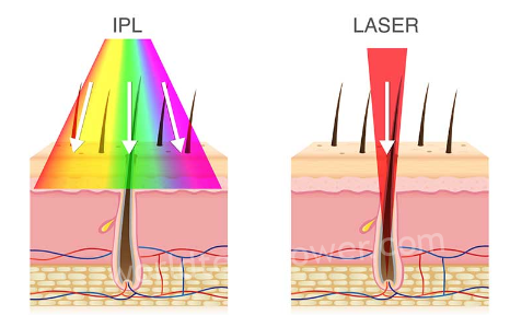 Screenshot 2070 – IPL And Laser For Hair Removal: What's The Difference? – World Tech Power